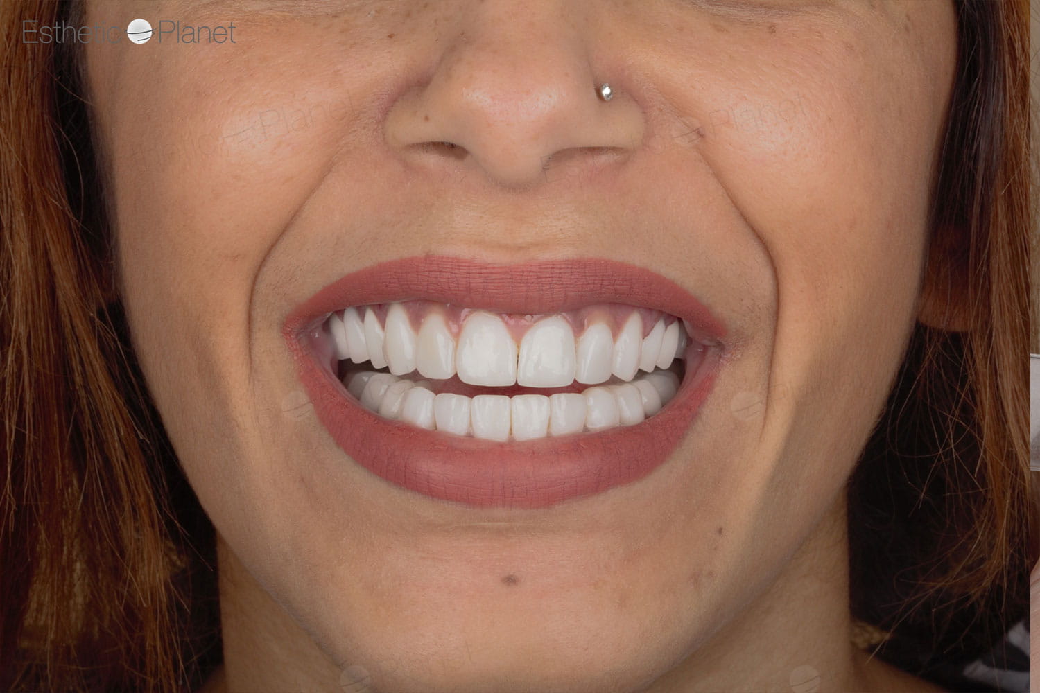 Facettes Dentaires — Dentaglobal