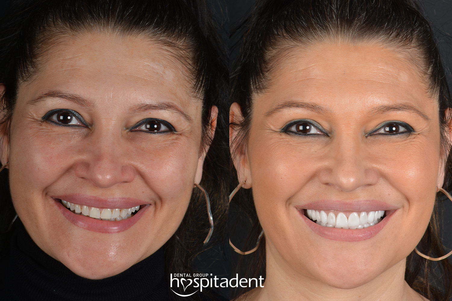 Hollywood Smile — Hospitadent