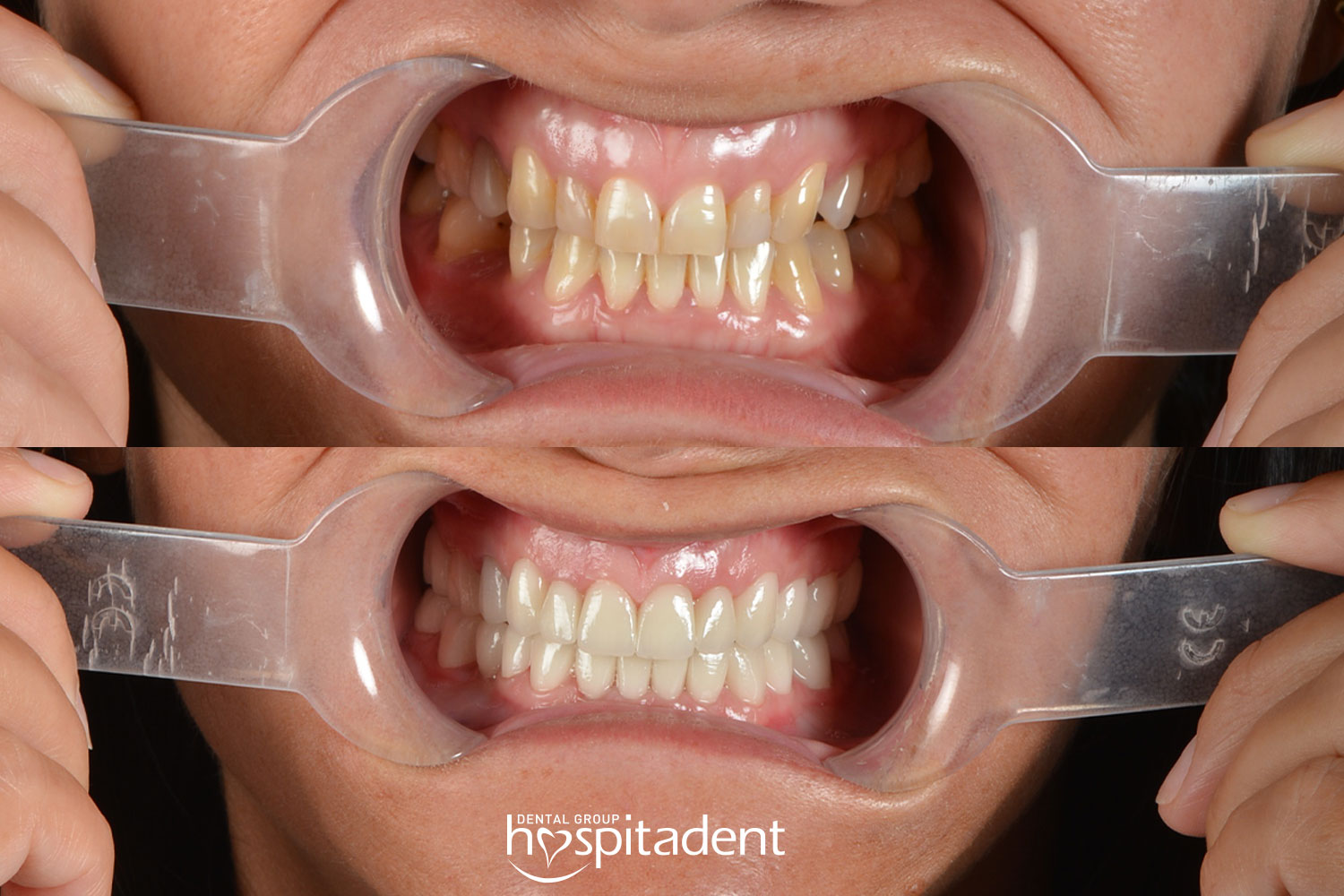 Hollywood Smile — Hospitadent