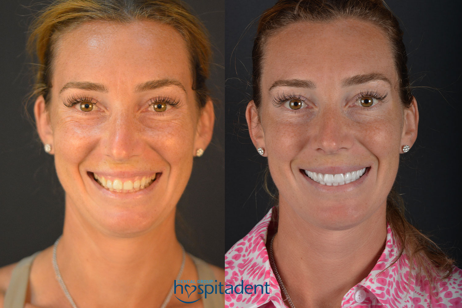 Hollywood Smile — Hospitadent