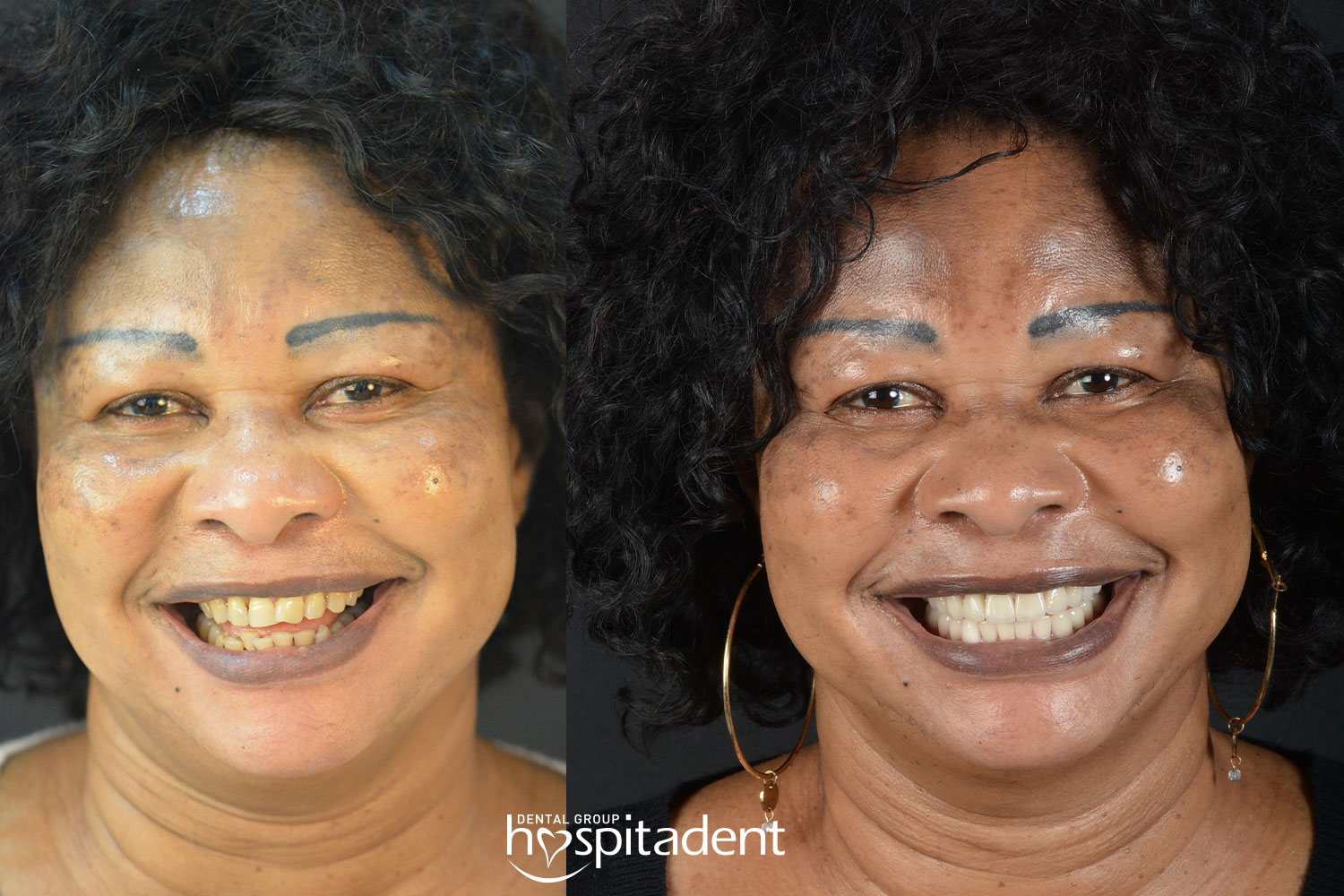 Hollywood Smile — Hospitadent