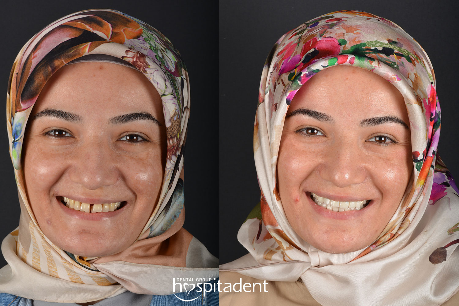 Hollywood Smile — Hospitadent