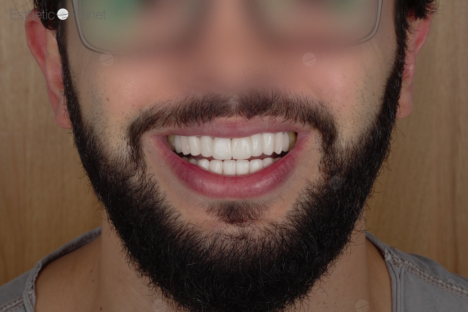 Facettes Dentaires — Dentaglobal