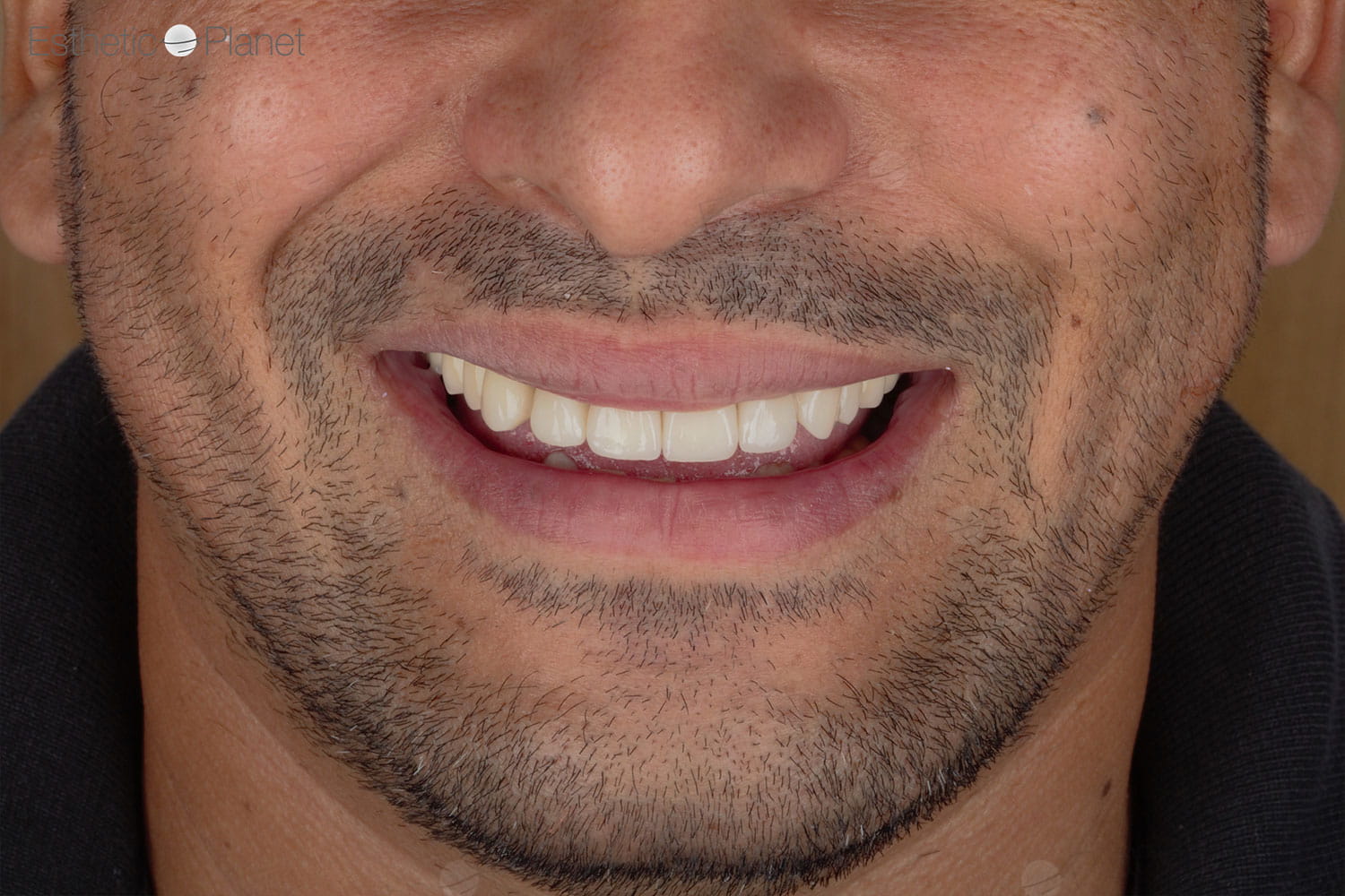 Facettes Dentaires — Dentaglobal