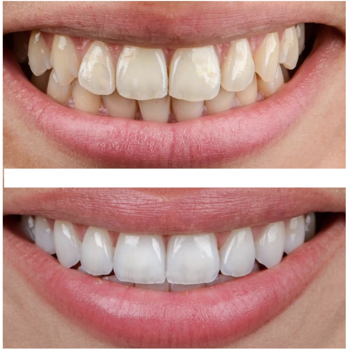 Facettes Dentaires — Swiss dental