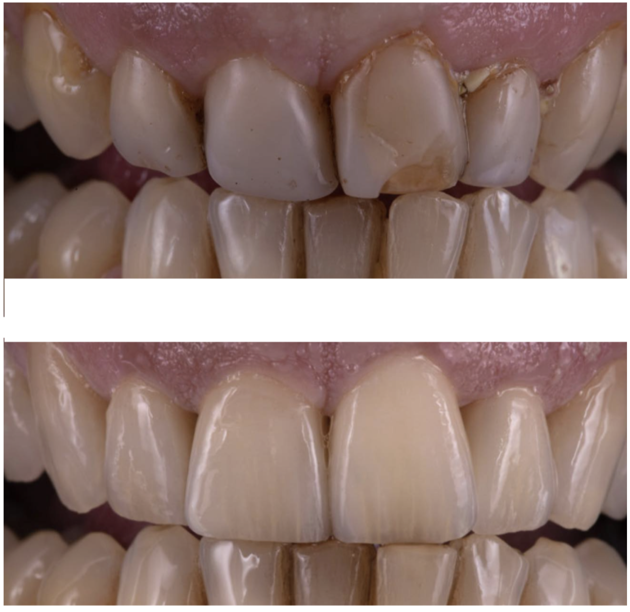 Couronnes Zircones — Swiss dental