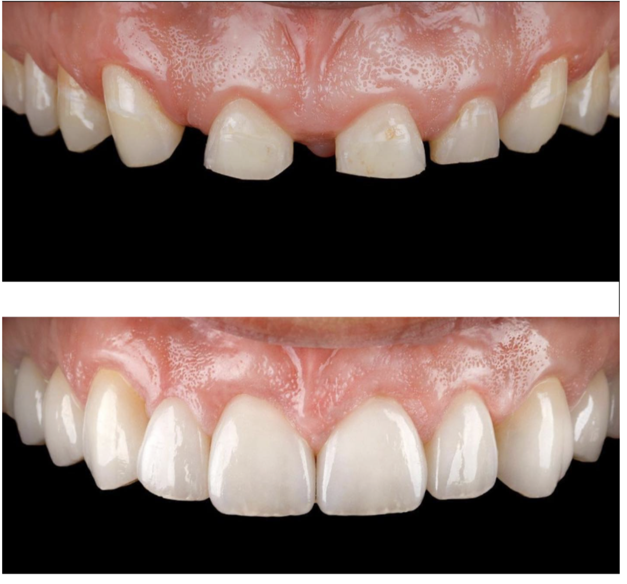 Couronnes Zircones — Swiss dental