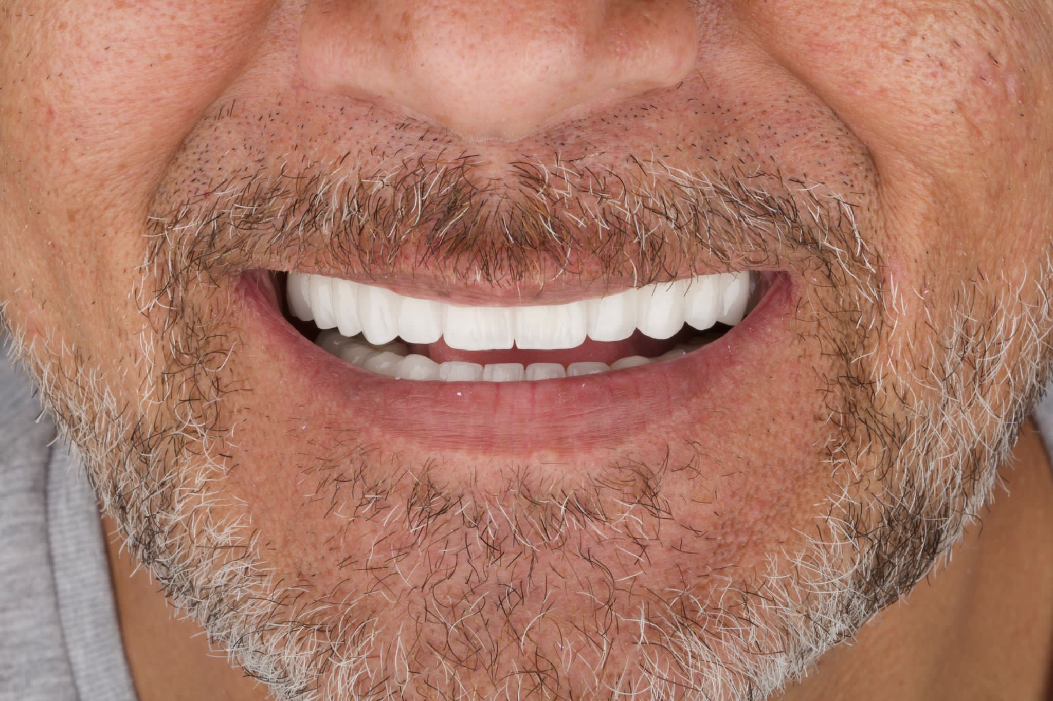 Couronnes Dentaires — Dentaglobal