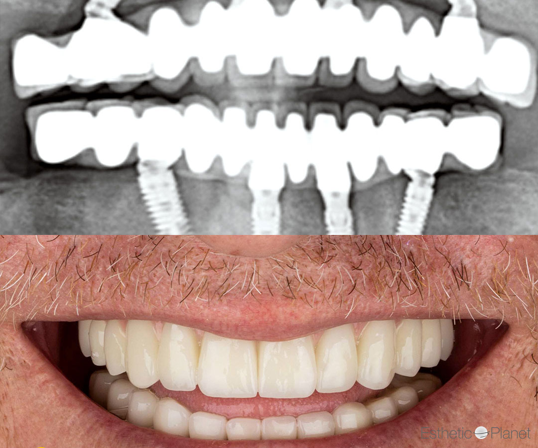 Corone dentali — Dentaglobal