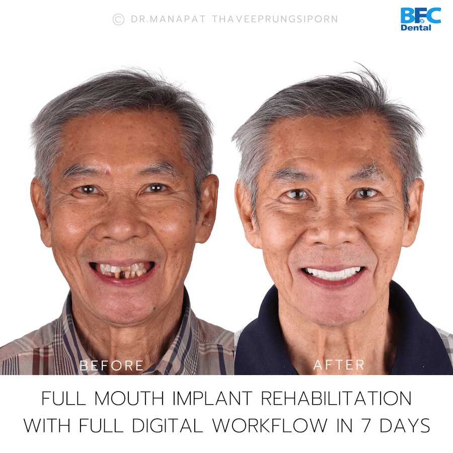 Reconstruction Totale — BFC Dental