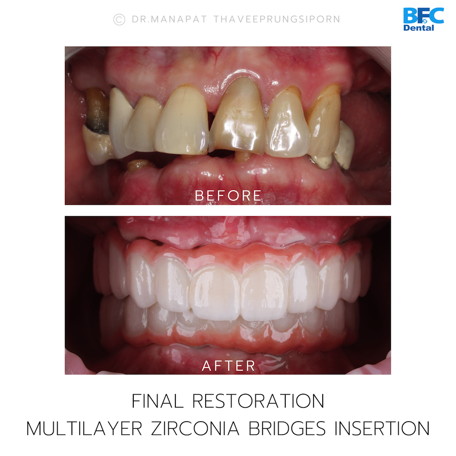 Reconstruction Totale — BFC Dental