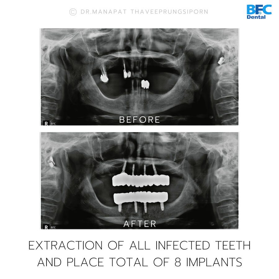 Reconstruction Totale — BFC Dental