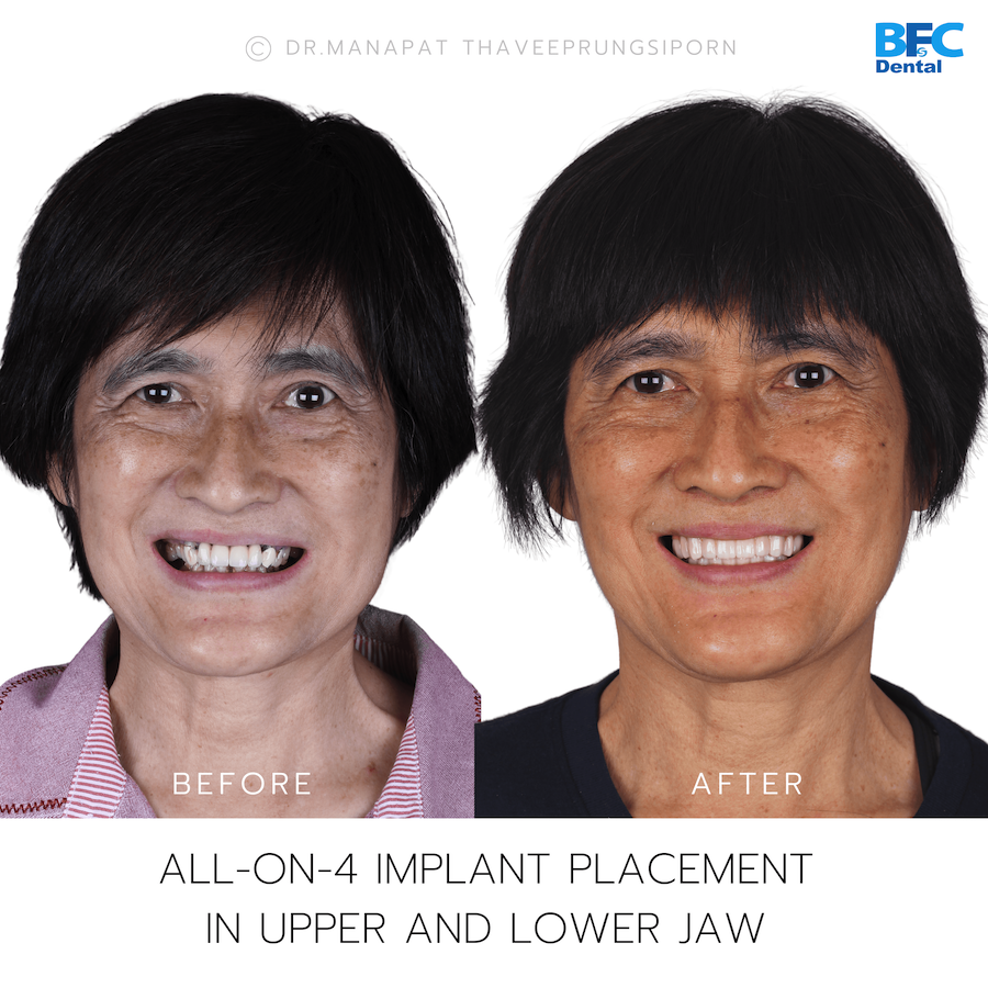 Reconstruction Totale — BFC Dental