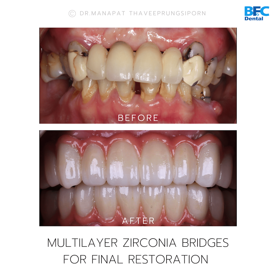 Reconstruction Totale — BFC Dental