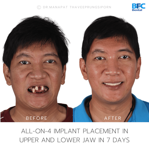 Reconstruction Totale — BFC Dental