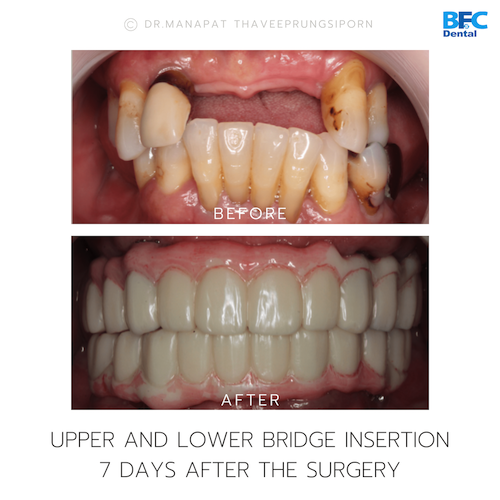 Reconstruction Totale — BFC Dental