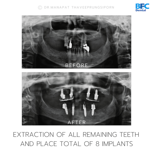 Reconstruction Totale — BFC Dental