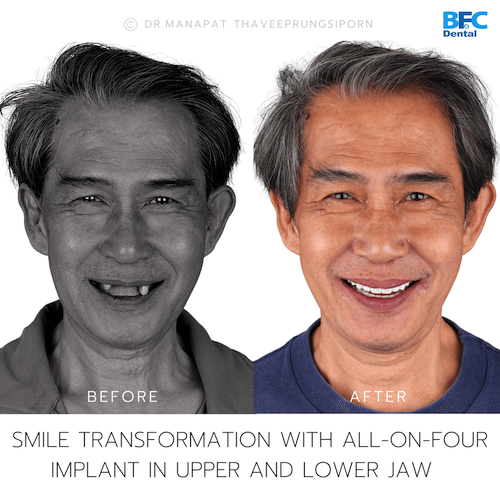Reconstruction Totale — BFC Dental