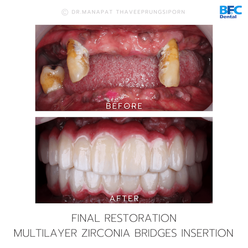 Reconstruction Totale — BFC Dental