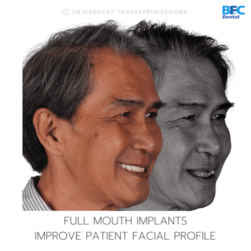 Reconstruction Totale — BFC Dental