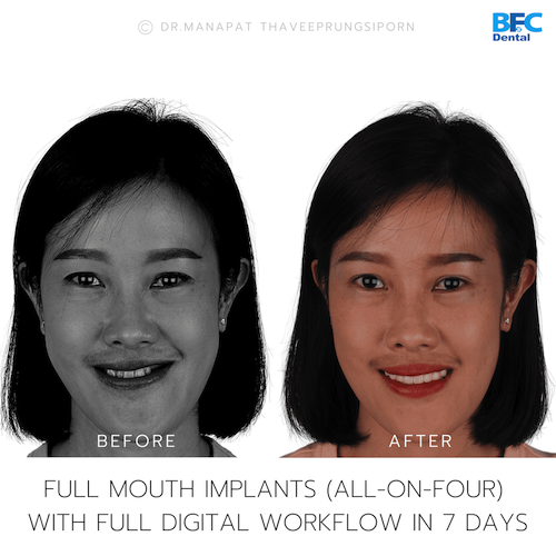 Reconstruction Totale — BFC Dental