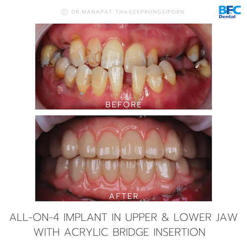 Reconstruction Totale — BFC Dental