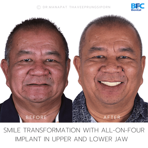 Reconstruction Totale — BFC Dental