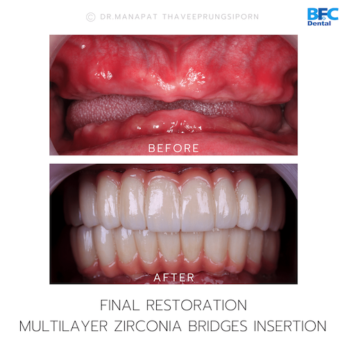 Reconstruction Totale — BFC Dental