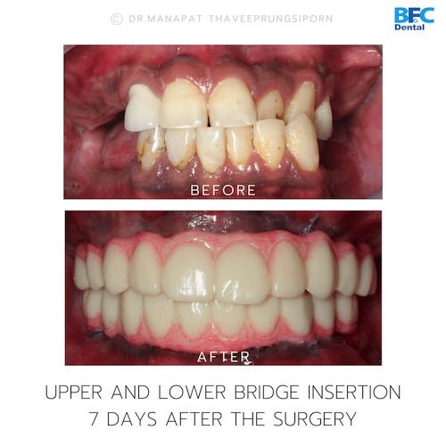 Reconstruction Totale — BFC Dental
