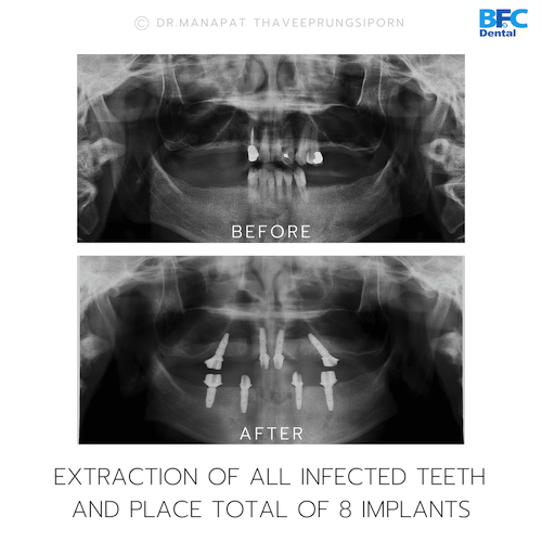 Reconstruction Totale — BFC Dental
