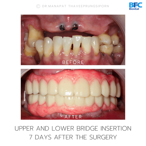 Reconstruction Totale — BFC Dental