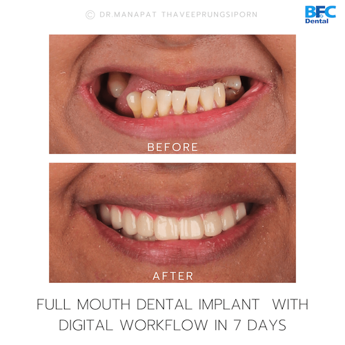 Reconstruction Totale — BFC Dental