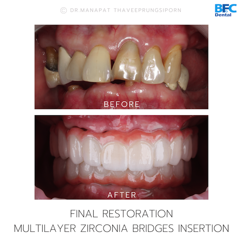 All-On-4 — BFC Dental