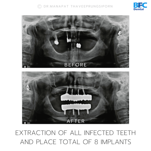 All-On-4 — BFC Dental