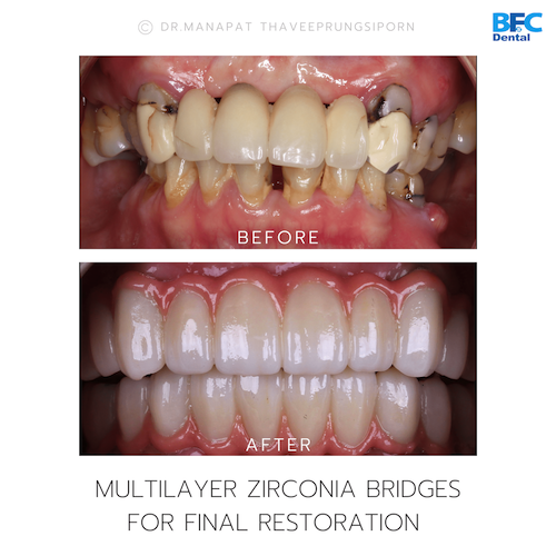 All-On-4 — BFC Dental
