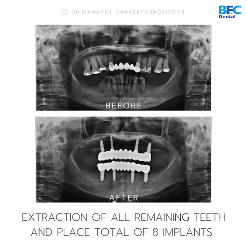 All-On-4 — BFC Dental