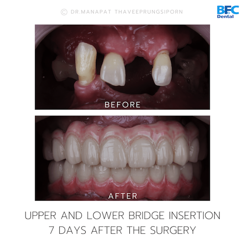 All-On-4 — BFC Dental