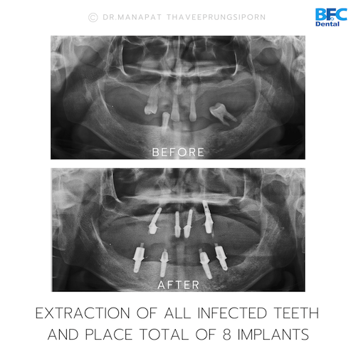 All-On-4 — BFC Dental