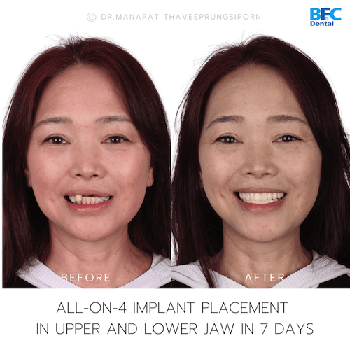 All-On-4 — BFC Dental