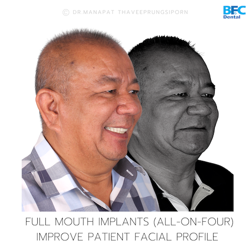 All-On-4 — BFC Dental