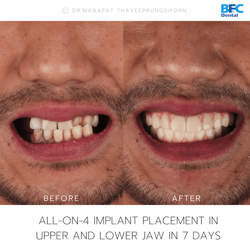 All-On-4 — BFC Dental