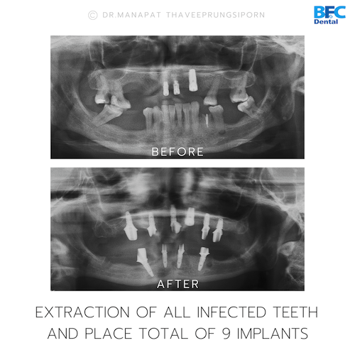 All-On-4 — BFC Dental