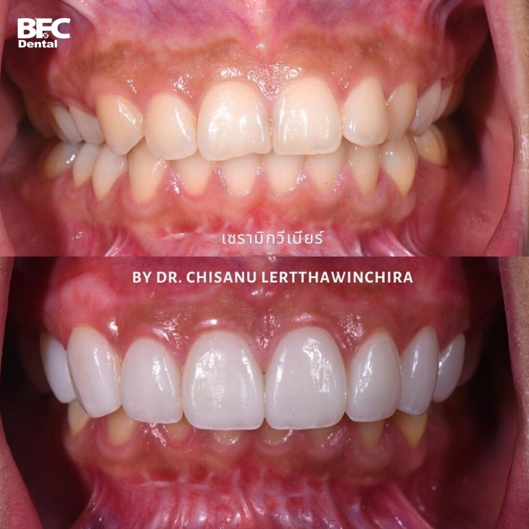 Facettes Dentaires — BFC Dental