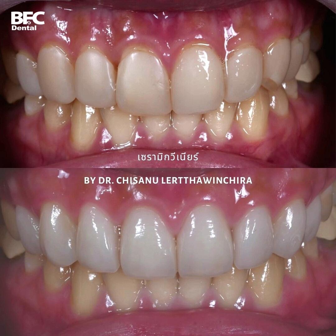 Facettes Dentaires — BFC Dental