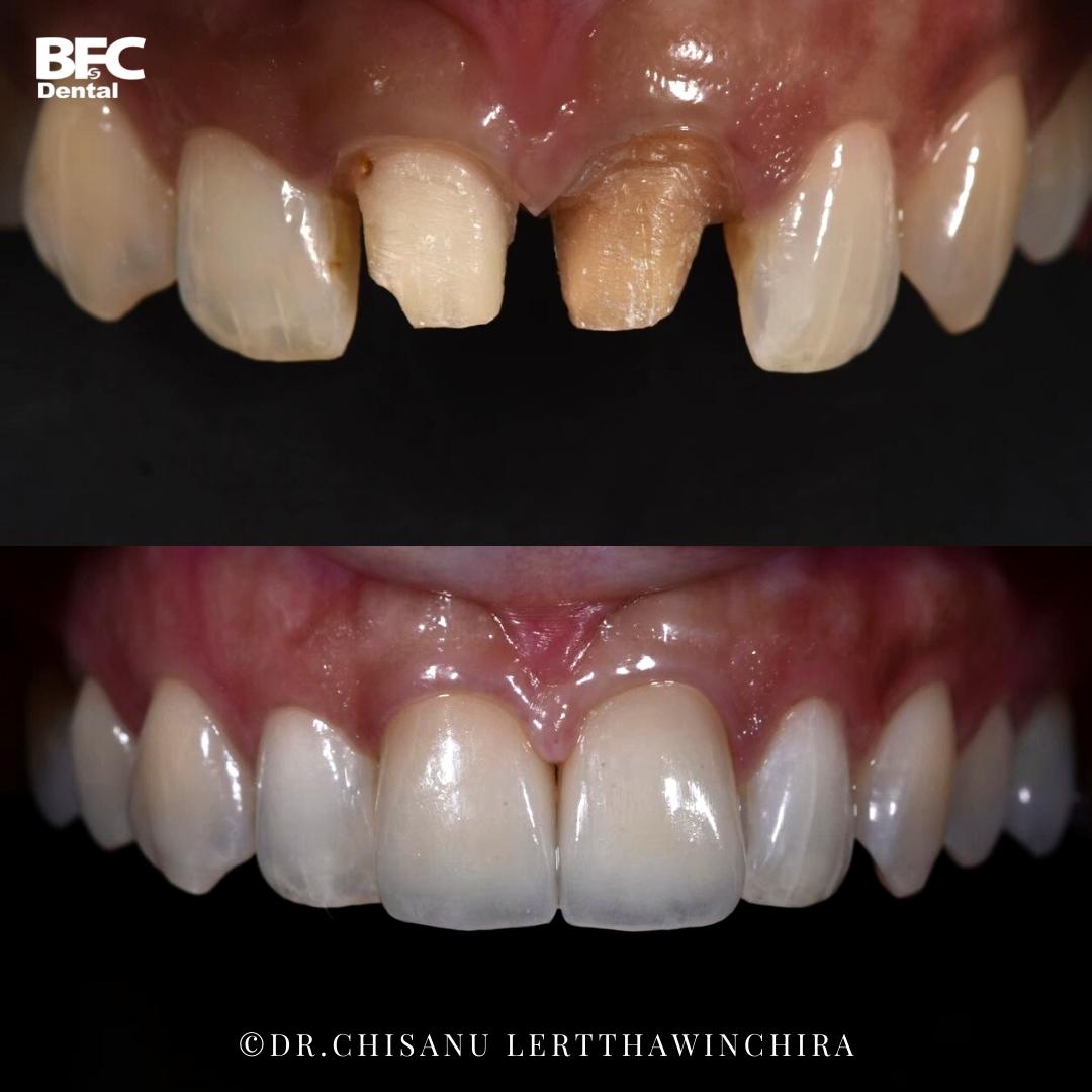 Facettes Dentaires — BFC Dental