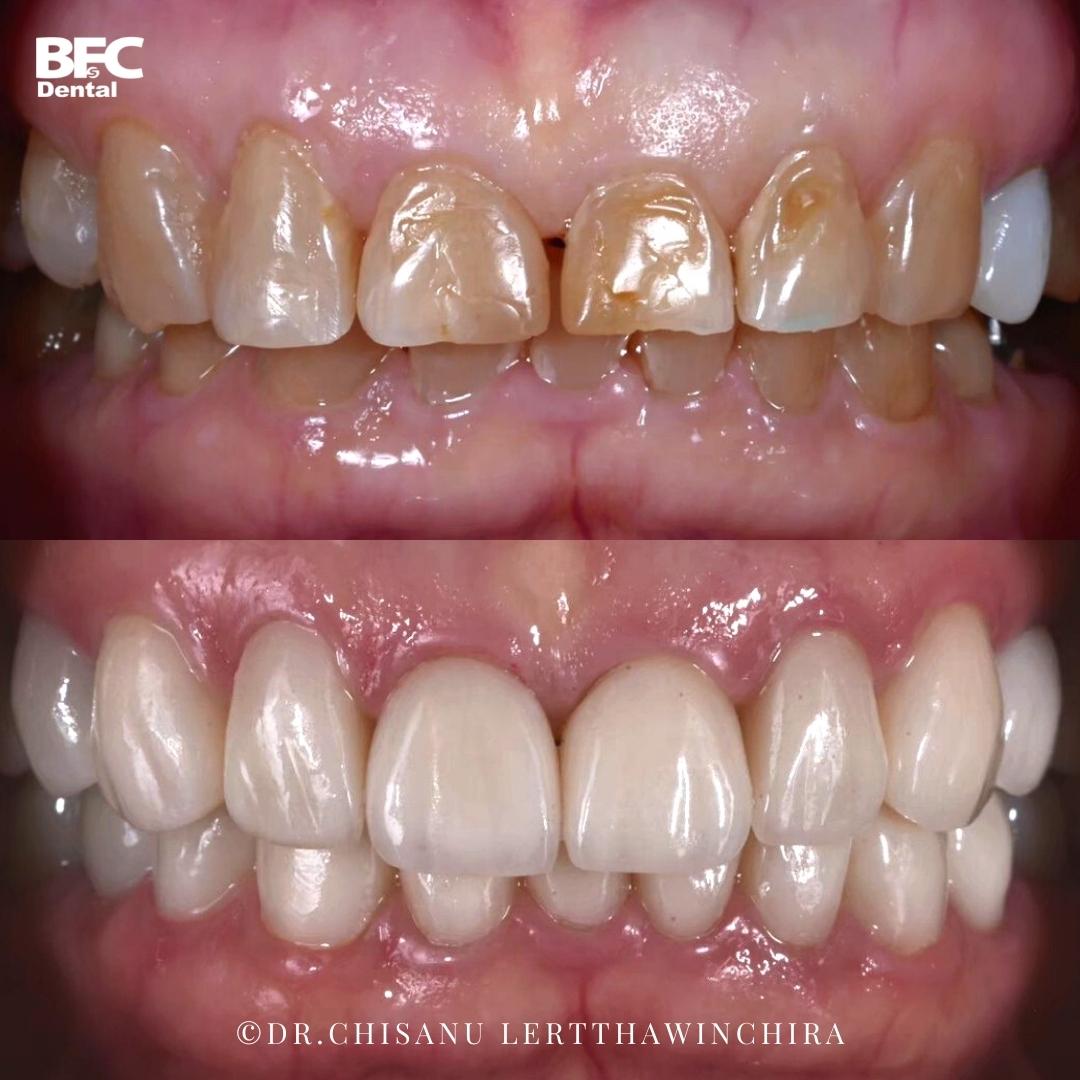 Facettes Dentaires — BFC Dental
