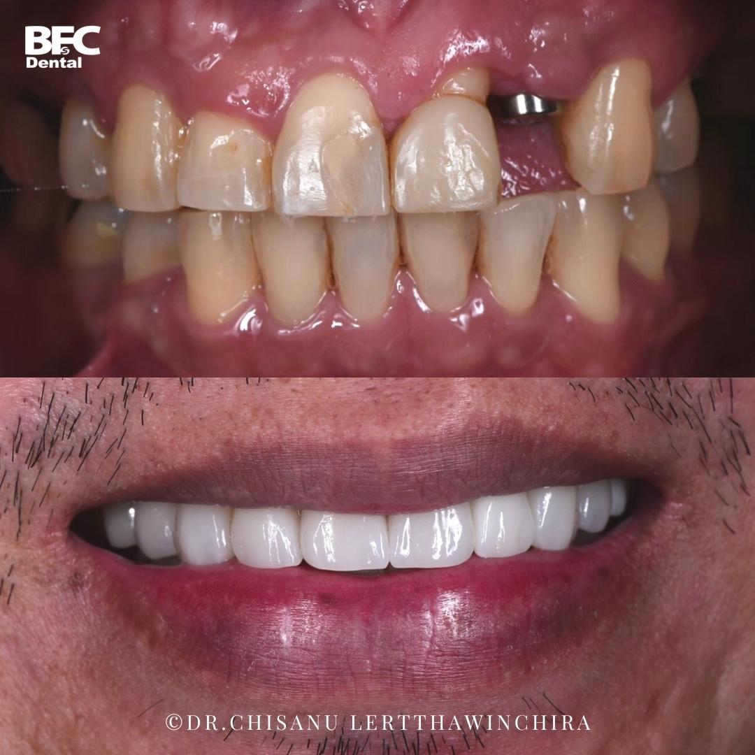Facettes Dentaires — BFC Dental