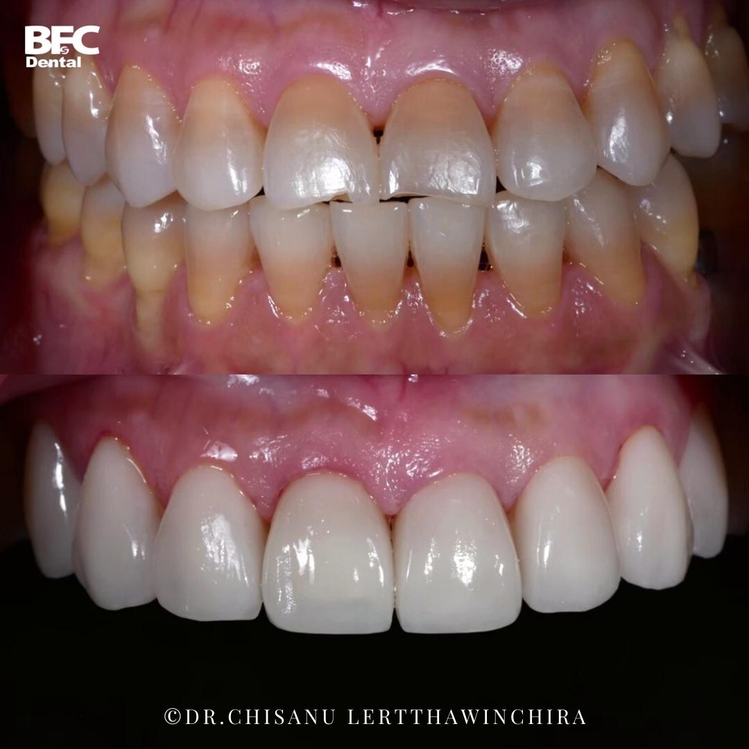 Facettes Dentaires — BFC Dental