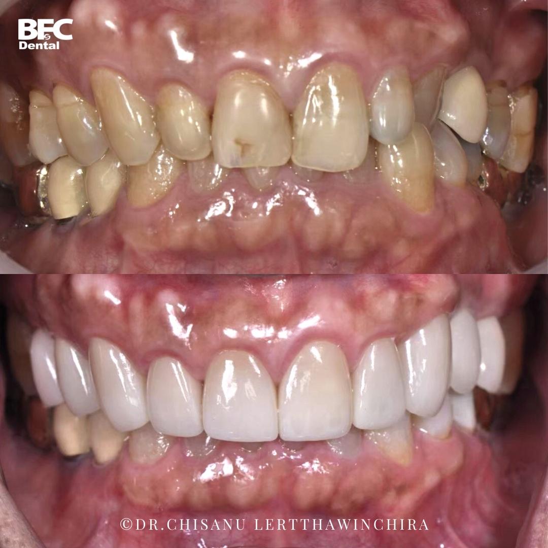 Facettes Dentaires — BFC Dental