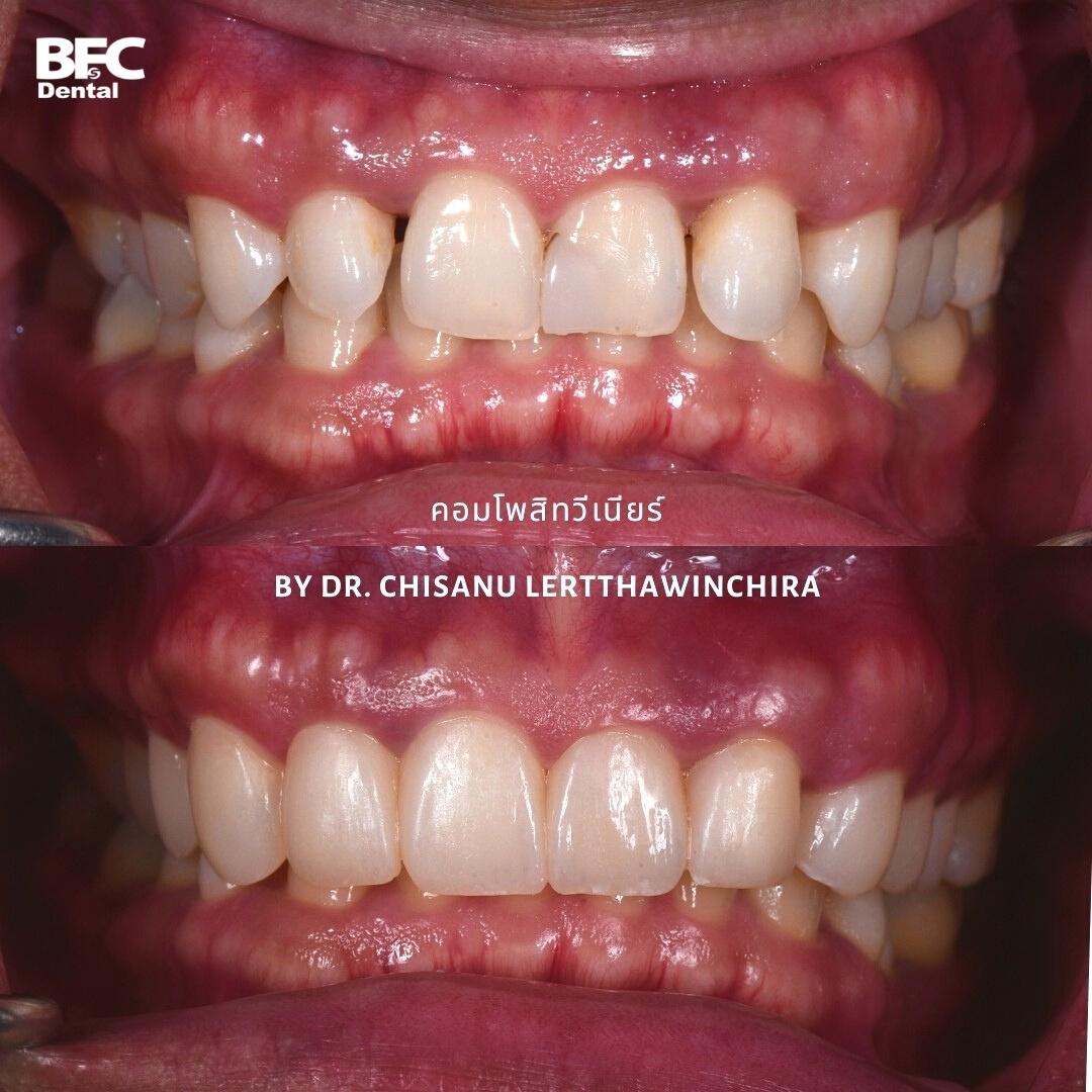 Facettes Dentaires — BFC Dental